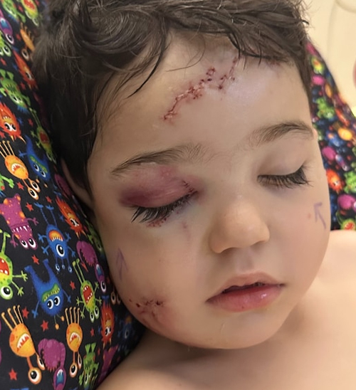 Four-year-old boy left with 'horrific' facial injuries after mauling by friend's pet 